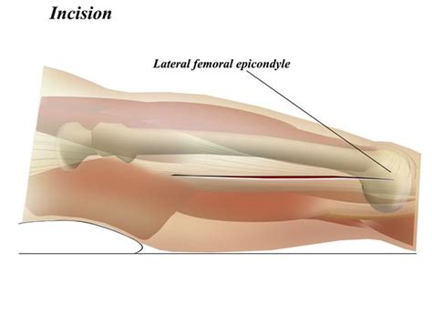 Femur Posterolateral Approach Approaches Orthobullets