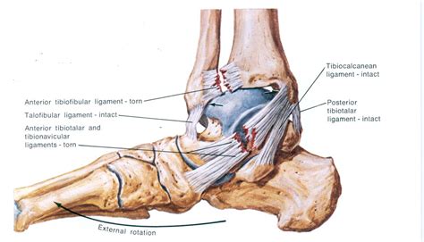 The three main ones on the outside part of your ankle are the anterior talofibular ligament, the posterior talofibular ligament, and the. Dorsal Calcaneocuboid Ligament damage treatment