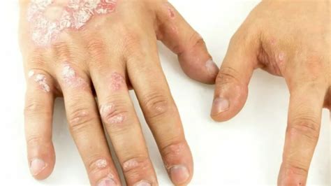 Understanding Plaque Psoriasis Causes Symptoms And Treatments
