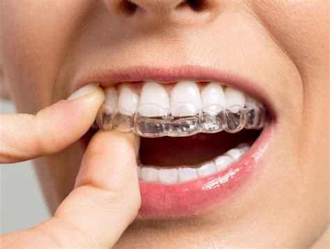 Profile Orthodontics4 Steps To Overbite Correction With Invisalign