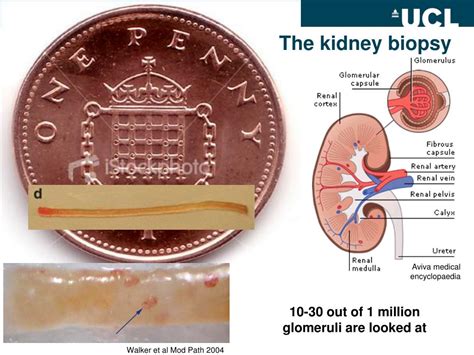 Ppt What Are Mpgndddc3g What Your Kidney Biopsy Tells Us