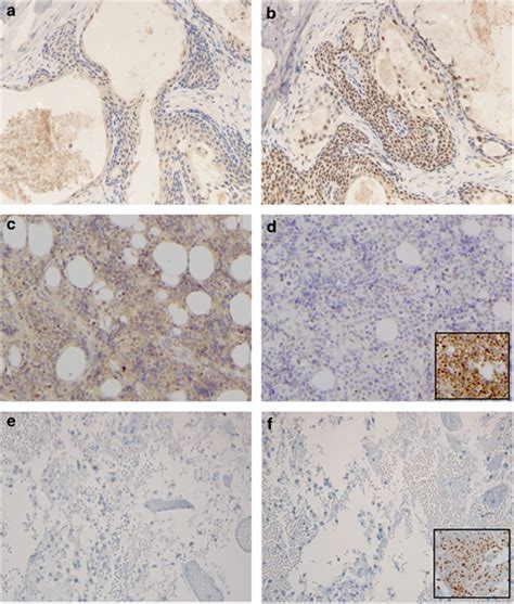 Photomicrographs showing IHC staining of the mismatch repair proteins 