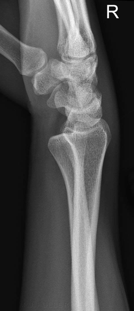 Subluxation Of The Distal Radioulnar Joint WikiRadiography