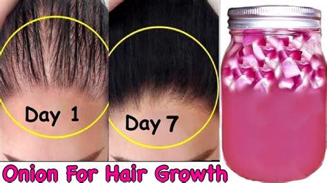 Onion For Extreme Hair Growth How To Use Onion Juice For Hair Growth