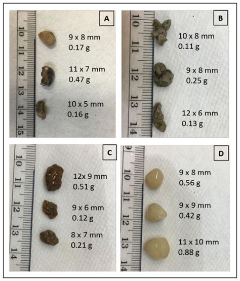 Kidney Stone Chart A Visual Reference Of Charts Chart Master