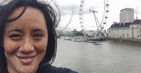 Mum So Bullied For Contagious Freckles She Wanted To Bleach Her Skin
