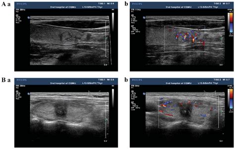 Conventional Ultrasound Of Papillary Thyroid Carcinoma Using Aa And