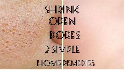 How To Shrink Open Pores How To Minimise Pores Permanently 100results Youtube