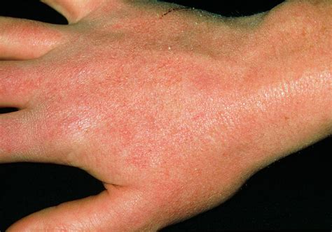 Dry Skin Reaction On Hand Due To Anti Acne Drug Photograph By Dr P