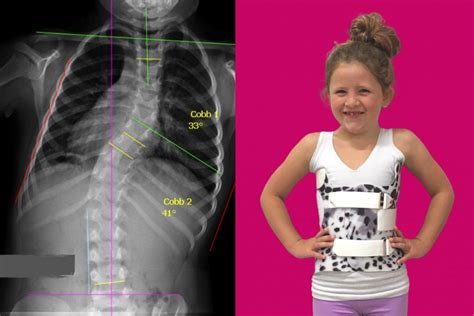 Does Your Child Have Scoliosis National Scoliosis Center