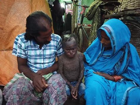 Kena Penyakit Kulit Langka, Anak Ini Dijuluki Manusia Ular ...
