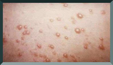 Eyes or fingers, although rare. Herpes Sores On Legs — Herpes Free Me