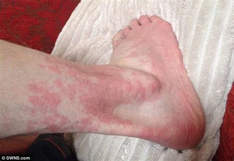 Allergic Reaction To Ibuprofen Causes Mans Skin To Erupt In Blisters