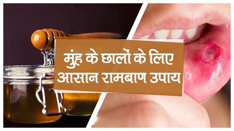 Mouth Ulcer Home Remedy Follow These Home Remedies To Cure Mouth