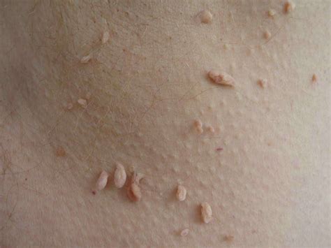 Skin Tags 10 Causes Of Skin Tags