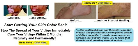 White Skin Discoloration Herbal Skin Cream For Vitiligo Extra Strength