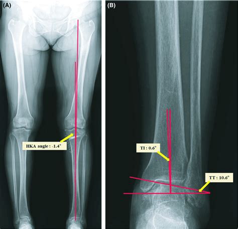 One Year After High Tibial Osteotomy Hto Whole Leg Radiographs Of A