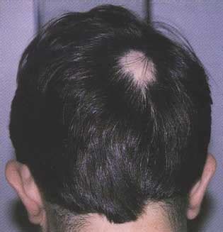 It may be caused by your immune. Health And Diseases Blog: ALOPECIA