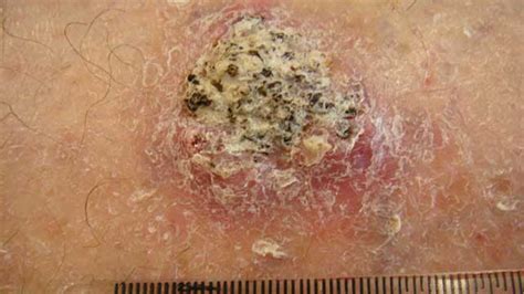 Skin Cancer Brown Spots