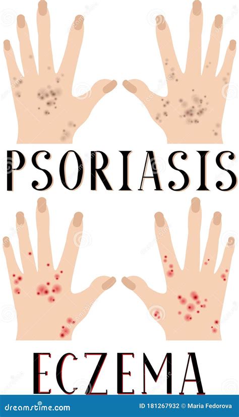 Psoriasis And Eczema Diseased Skin Sore Hands Medical Poster
