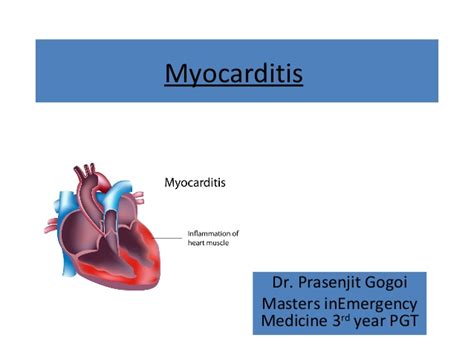 The presence of myocyte necrosis is required for certain types of myocarditis — specifically, lymphocytic myocarditis that is. Myocarditis