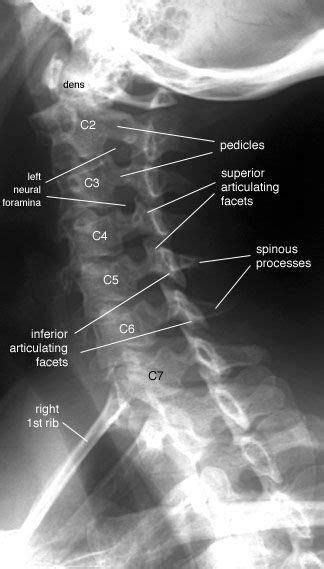 Cervical Spine X Ray Cervical Spine Left Anterior Oblique View