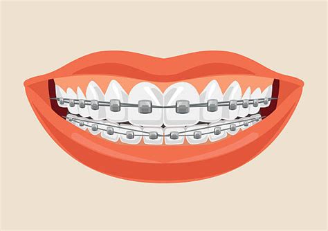 Braces Cartoon Clipart 20 Free Cliparts Download Images On Clipground