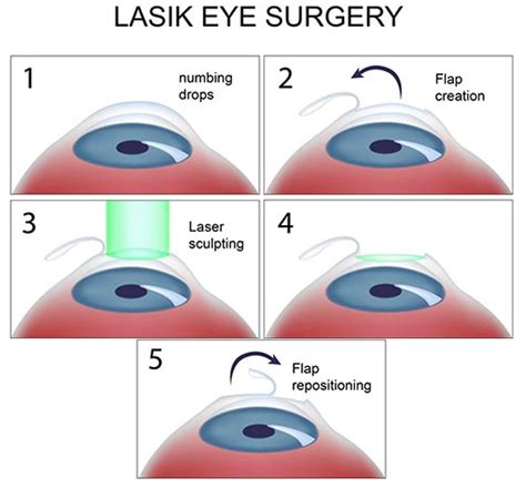 Lasik Eye Surgery For Astigmatism What You Need To Know