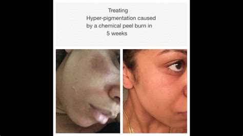 Best at home chemical peels for hyperpigmentation. Treating Hyperpigmentation Caused By A Chemical Peel - YouTube