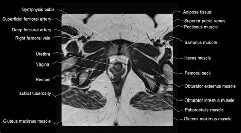 Pelvis Muscles Mri Anatomy Normal And Variant Pelvic Anatomy On Mri