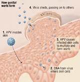 The human papillomavirus (hpv) is responsible for a common sexually transmitted infection that in this article, learn what hpv is, how it spreads, the symptoms it causes, and their treatments. Human Papilloma Virus (HPV) - Harvard Health
