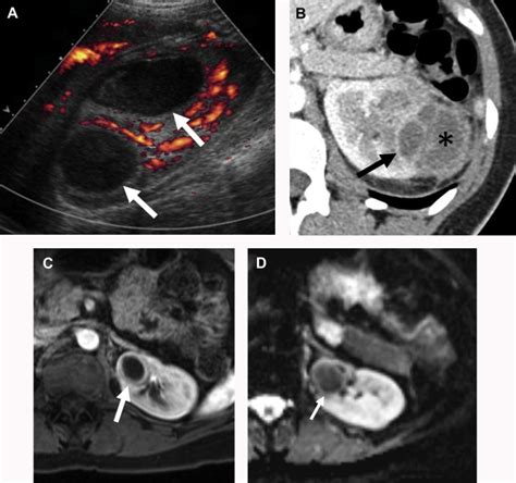 Imaging Of Renal Infections And Inflammatory Disease Radiology Key