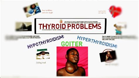 Thyroid Problems Symptoms And Causes Goiter Hyperthyroidism And