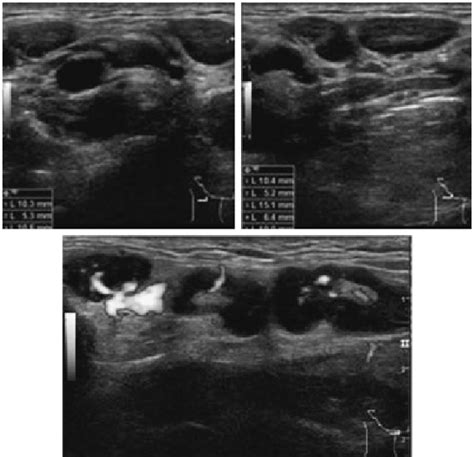 Ultrasonography Revealed Large Number Of Swollen Cervical Lymph