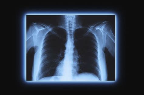 Do X Ray Machines Contain Radioactive Material Concerne La Machine
