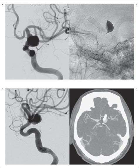 Figure From Endovascular Treatment Of Intracranial Aneurysms In The