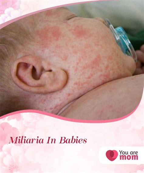 Miliaria In Babies Miliaria In Babies Also Known As Sudamina Is More