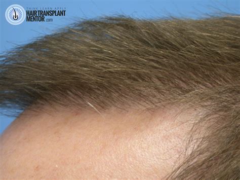 Hair Transplant 3 Month Results