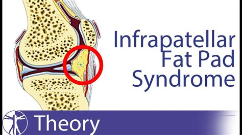 Infrapatellar Fat Pad Syndrome Hoffas Fat Pad Youtube
