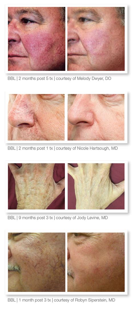 Bbl Before After Dean Dermatology And Skin Therapy