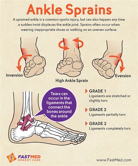 Do I Have A Sprained Ankle Infographic Sprained Ankle Sprain