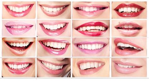The Three Types Of Smiles Wellington Dentist West Palm Beach