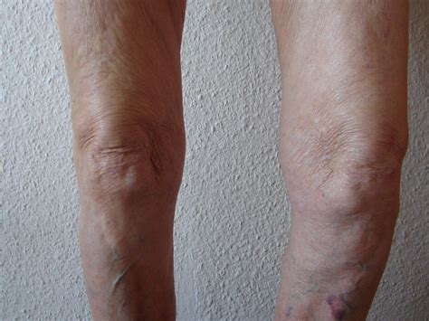 Nach einem kreuzbandriss ist die frage nach der heilungsdauer oftmals etwas, was sich … grundsätzlich ist nach der op. Das Arthroserisiko steigt: Daran ändert auch eine ...