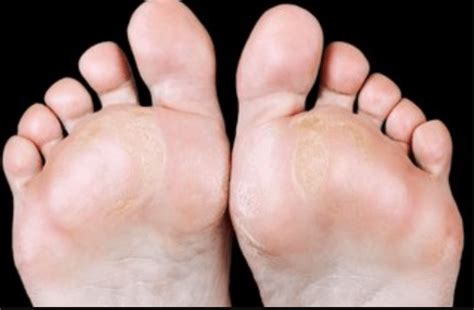 Bursitis Docmartins Foot And Ankle Clinics