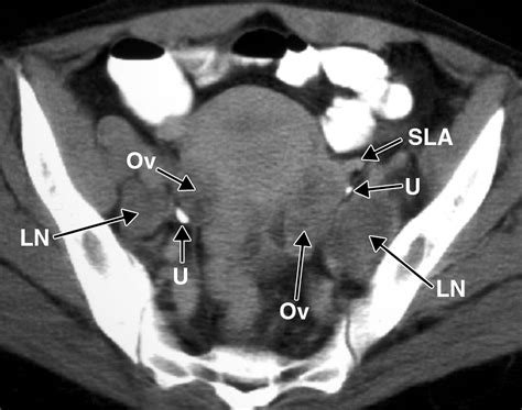 recognition of the ovaries and ovarian origin of pelvic masses with ct radiographics