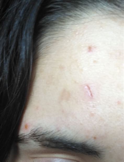 Atrophic Scar In Forehead Scar Treatments