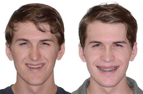 Double Jaw Orthognathic Surgery Corrective Jaw Surgery Dr Antipov