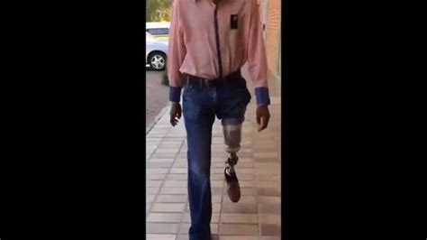 Walking With His New Prosthetic Leg Youtube