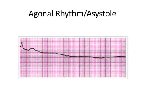 pulseless electrical activity vs asystole