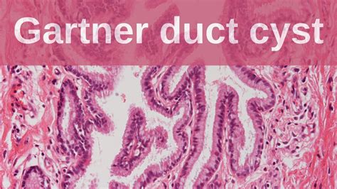 Gartner Duct Cyst Pathology Mini Tutorial YouTube